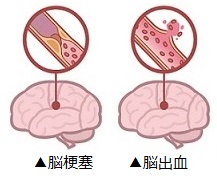 脳卒中イメージ図